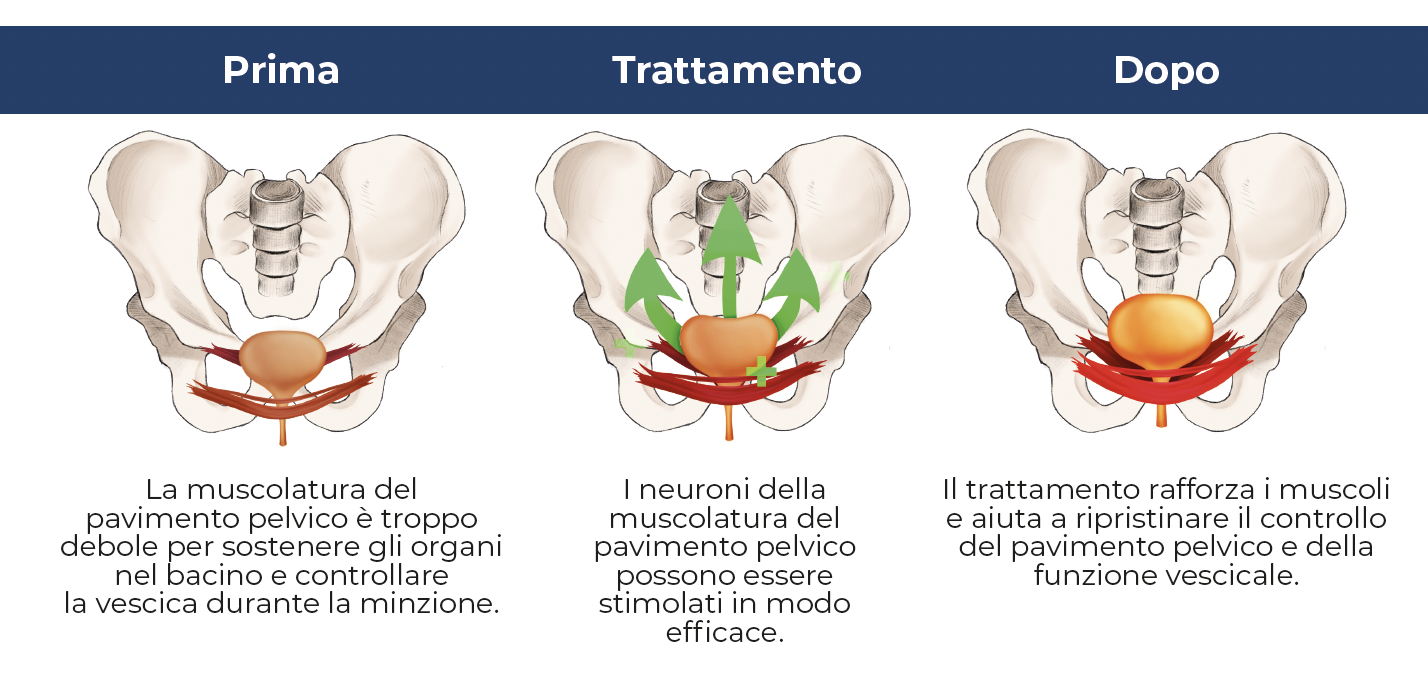 Novità: La sedia per il pavimento pelvico BetterPelvi